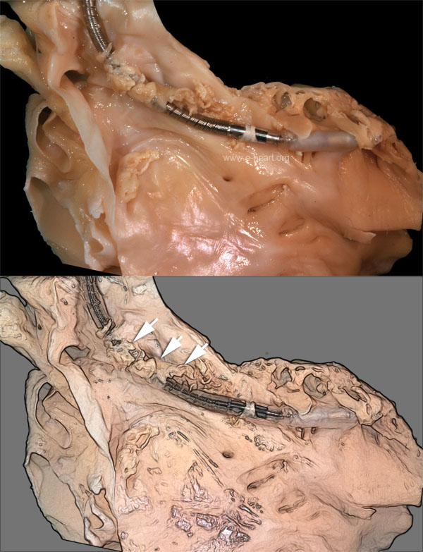 Pacemaker lead endocarditis